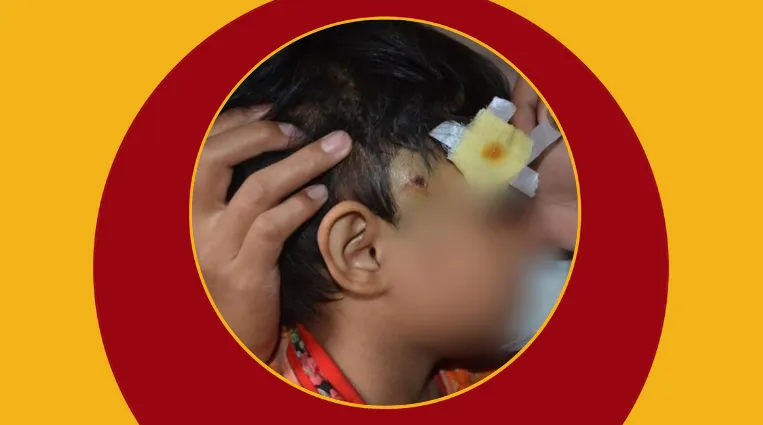 Five-year-old girl paralysed by untreated shrapnel injury after military shelling in Kalay